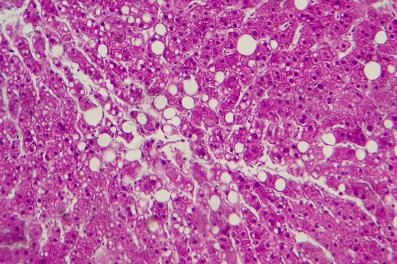 Light micrograph revealing liver tissue with fatty infiltration, indicative of hepatic steatosis or fatty liver disease