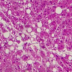 Light micrograph revealing liver tissue with fatty infiltration, indicative of hepatic steatosis or fatty liver disease