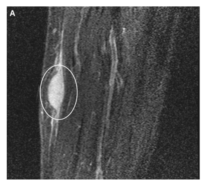 An MRI scan of the tumor in the surrounding flesh. It appears as an oval shape close to the surface of the skin. An MRI scan of the tumor in the surrounding flesh. It appears as an oval shape close to the surface of the skin.