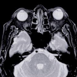A scan of the brain and eyes, to illustrate the visual cortex