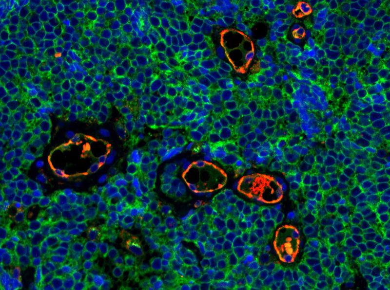 mmunofluorescent staining of Merkel cell carcinoma tumor tissue illustrating expression of CD200 (green) on the surface of tumor cells. CD200 plays a role in immunosuppression. The endothelial marker CD31 (red) highlights blood vessels. Merkel cell carcinoma is a rare and aggressive skin cancer.