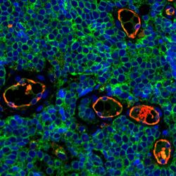 mmunofluorescent staining of Merkel cell carcinoma tumor tissue illustrating expression of CD200 (green) on the surface of tumor cells. CD200 plays a role in immunosuppression. The endothelial marker CD31 (red) highlights blood vessels. Merkel cell carcinoma is a rare and aggressive skin cancer.