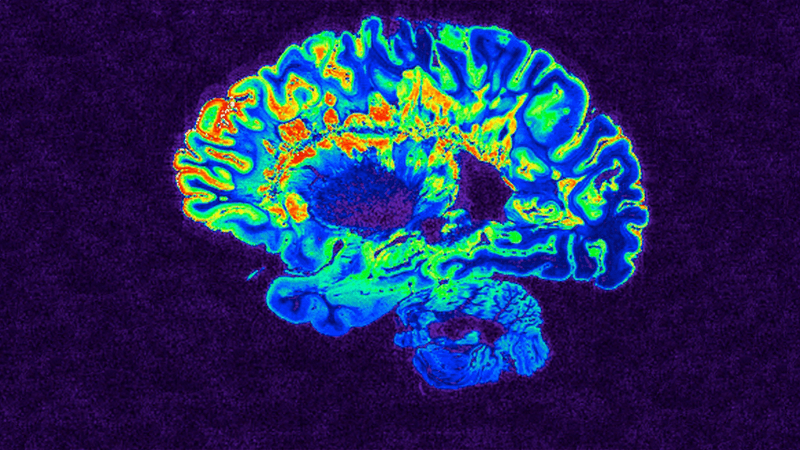 This is a pseudo-colored image of high-resolution gradient-echo MRI scan of a fixed cerebral hemisphere from a person with multiple sclerosis.