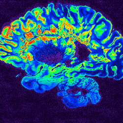 This is a pseudo-colored image of high-resolution gradient-echo MRI scan of a fixed cerebral hemisphere from a person with multiple sclerosis.