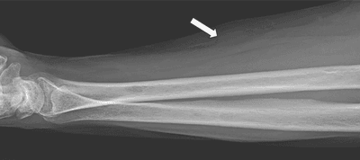 An x-ray image showing the right forearm. The patient's radius and ulna are clearly visible and so is the wrist, which is positioned at the far left of the image. Around half way along the forearm is a white arrow indicating where the tumor is.
